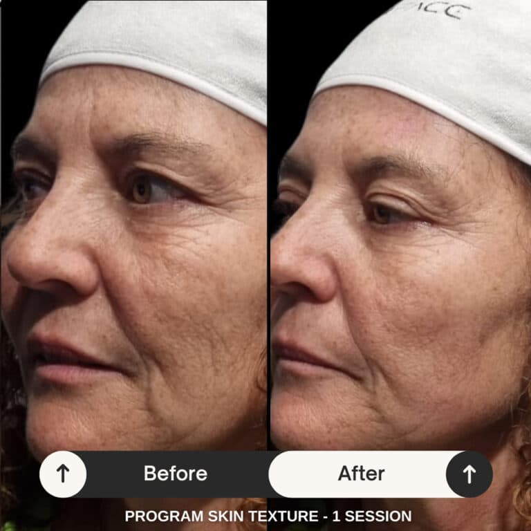 Before / after — Wonder Face program Skin Texture, 1 seansa